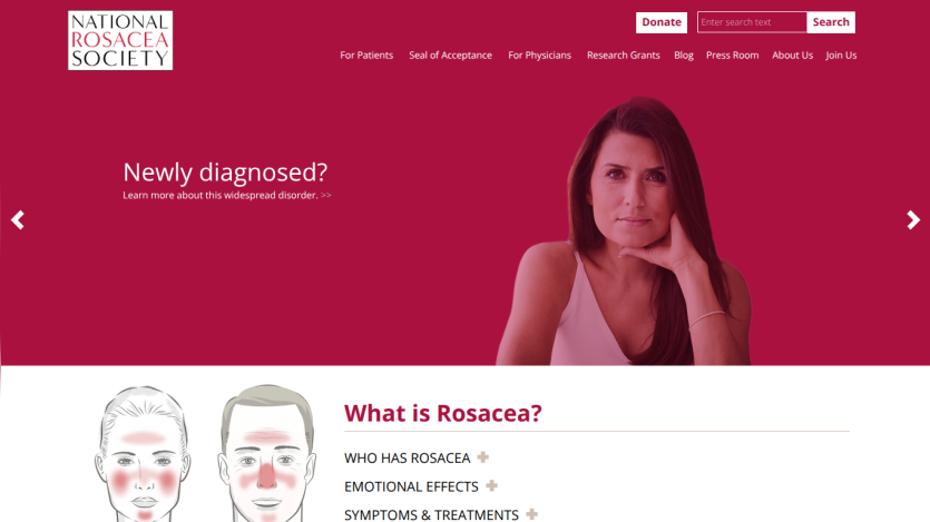 Homepage of the National Rosacea Society featuring a woman and information about rosacea.